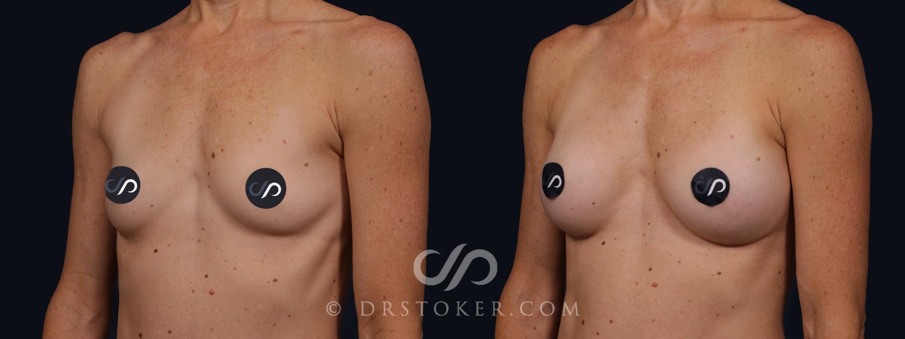 Before & After Breast Augmentation, Rapid Recovery Case 2065 Left Oblique View in Los Angeles, CA