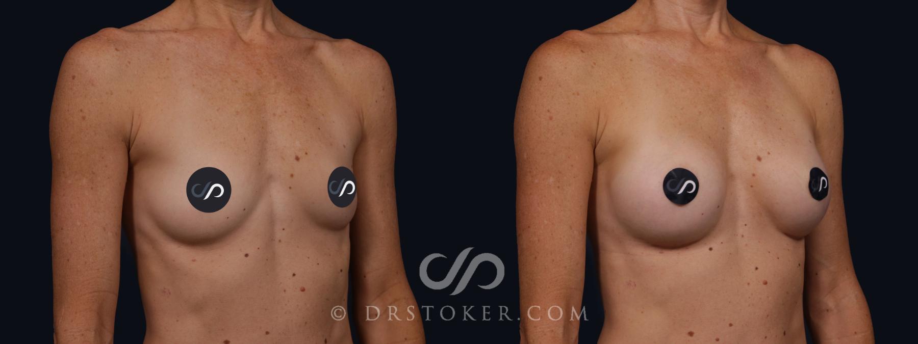 Before & After Breast Augmentation, Rapid Recovery Case 2065 Right Oblique View in Los Angeles, CA