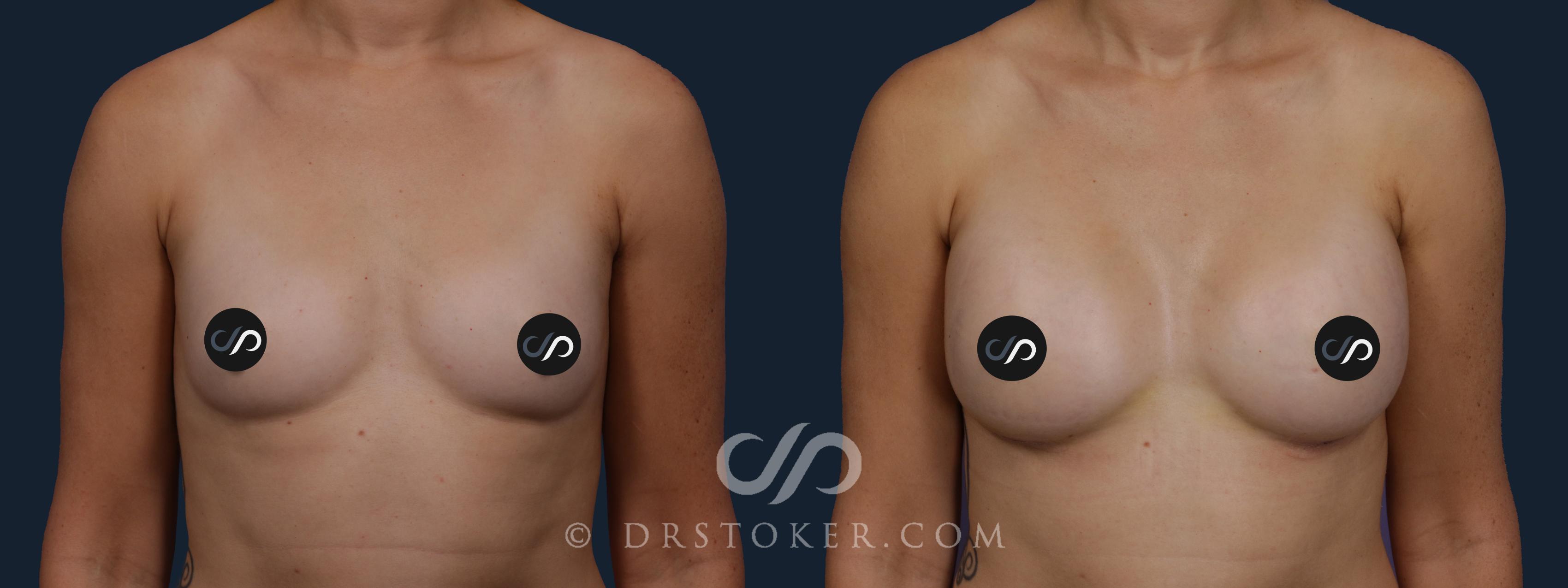 Before & After Breast Augmentation, Rapid Recovery Case 2084 Front View in Los Angeles, CA
