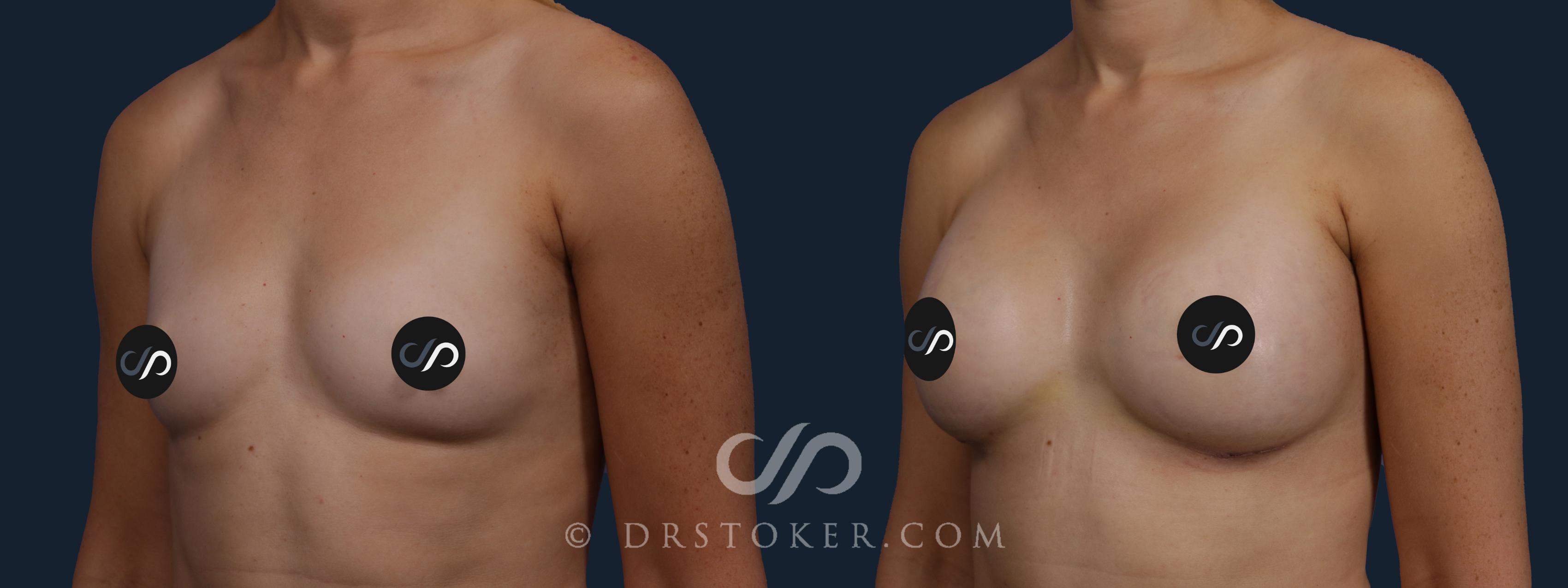 Before & After Breast Augmentation, Rapid Recovery Case 2084 Left Oblique View in Los Angeles, CA