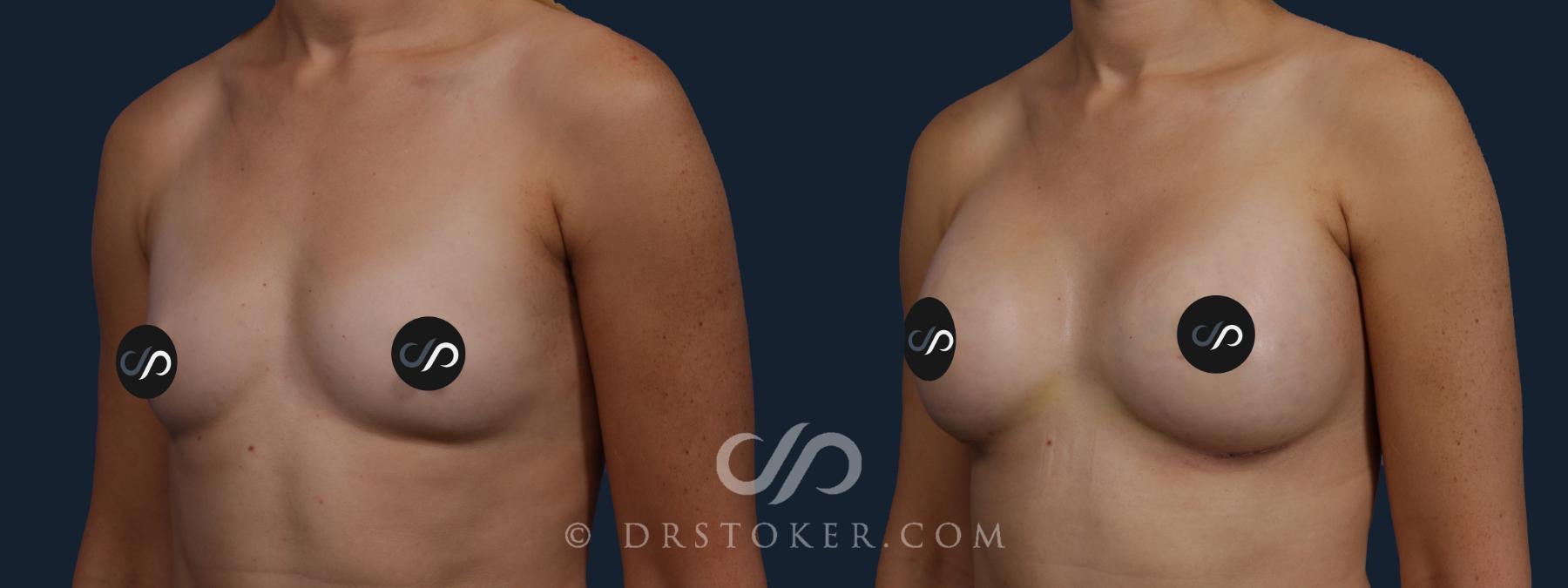 Before & After Breast Augmentation, Rapid Recovery Case 2084 Left Oblique View in Los Angeles, CA