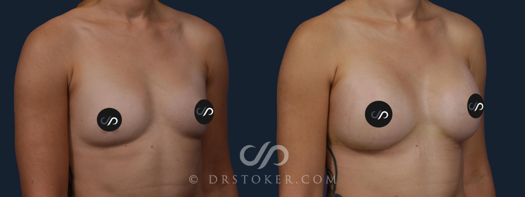 Before & After Breast Augmentation, Rapid Recovery Case 2084 Right Oblique View in Los Angeles, CA