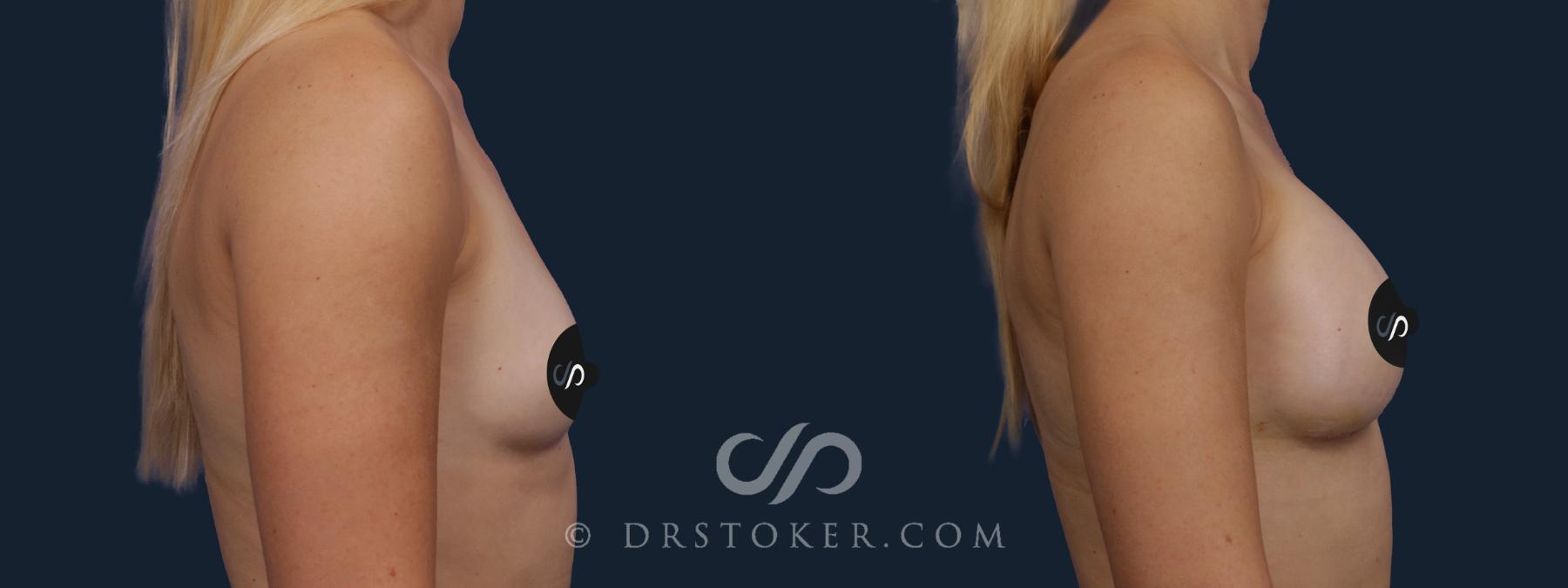 Before & After Breast Augmentation, Rapid Recovery Case 2084 Right Side View in Los Angeles, CA