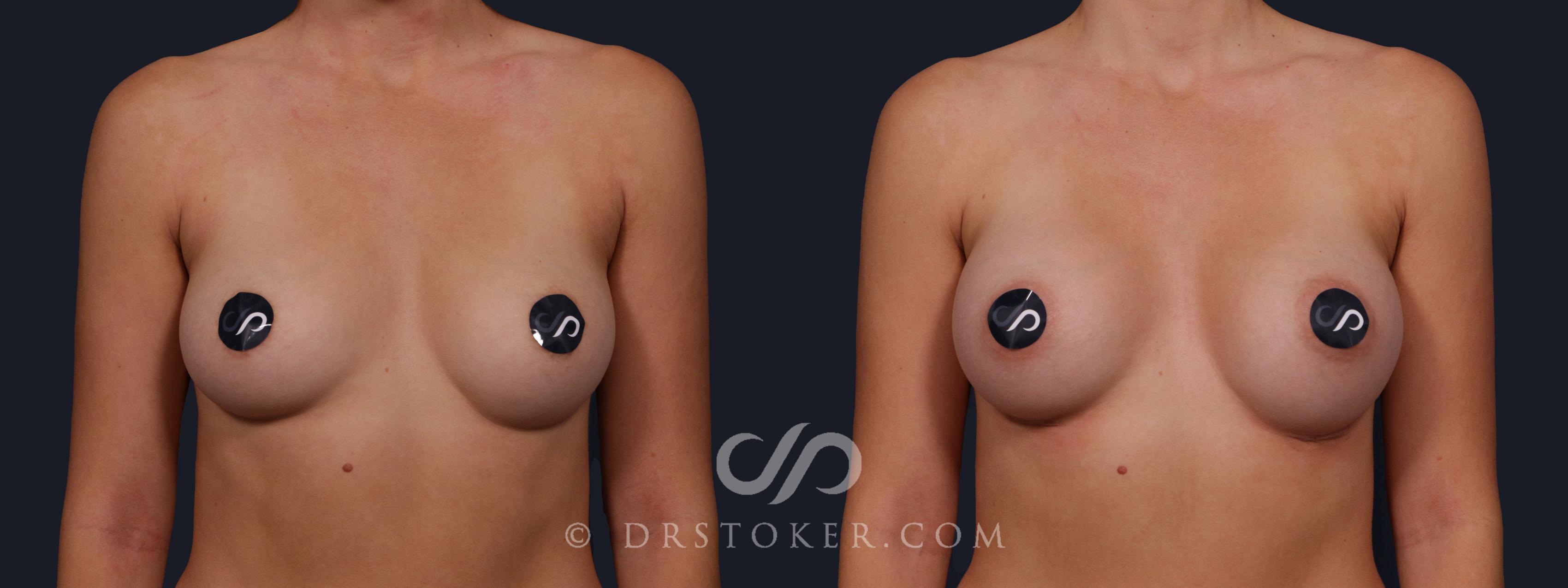 Before & After Breast Augmentation, Rapid Recovery Case 2136 Front View in Los Angeles, CA