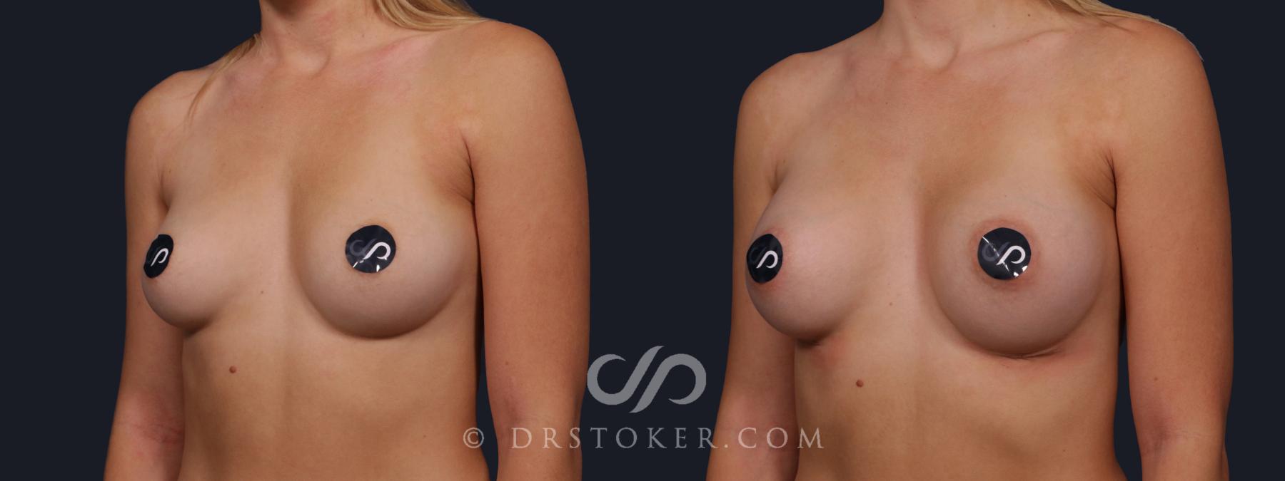 Before & After Breast Augmentation, Rapid Recovery Case 2136 Left Oblique View in Los Angeles, CA