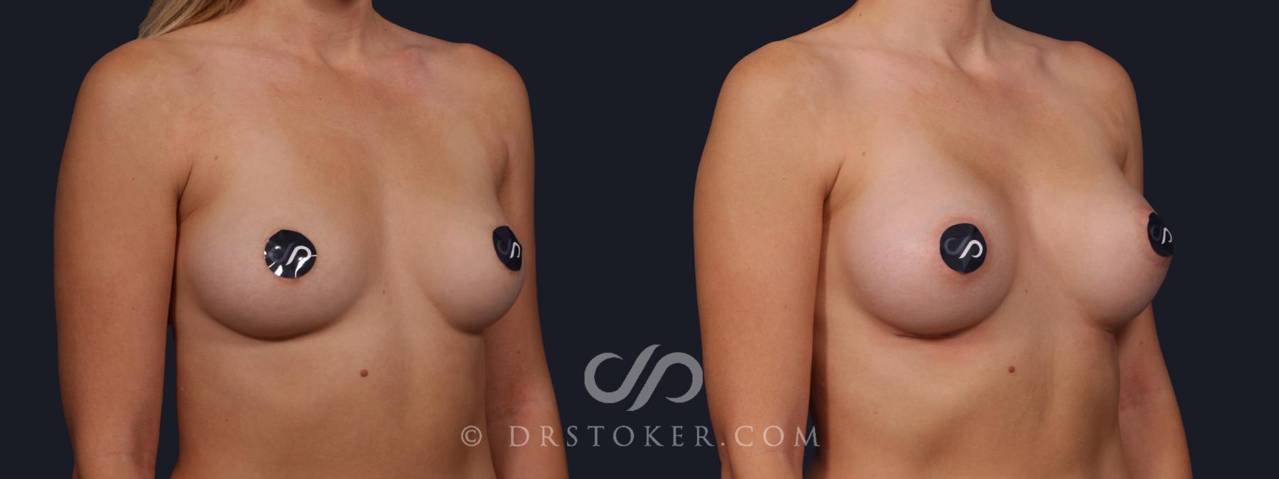 Before & After Breast Augmentation, Rapid Recovery Case 2136 Right Oblique View in Los Angeles, CA