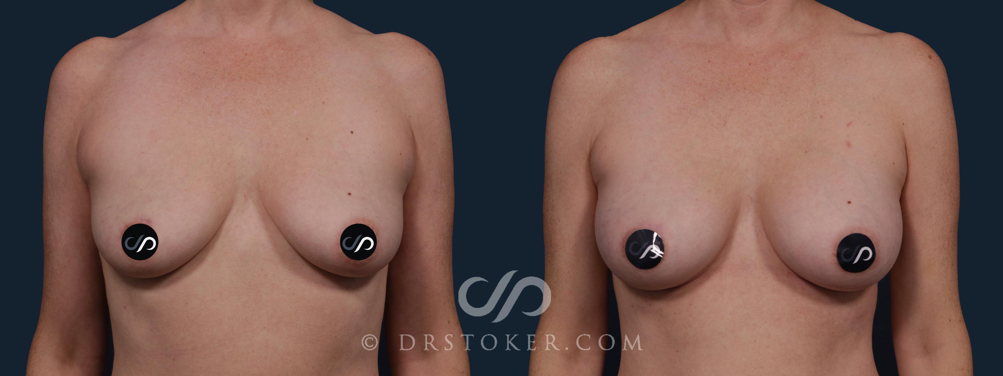 Before & After Breast Augmentation, Rapid Recovery Case 2139 Front View in Los Angeles, CA
