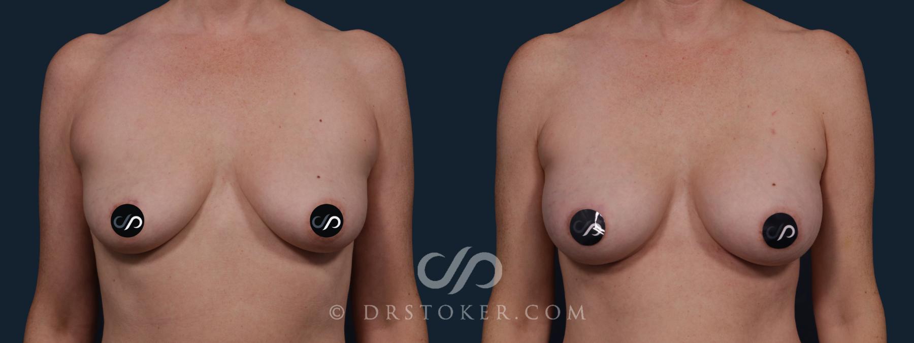 Before & After Breast Augmentation, Rapid Recovery Case 2139 Front View in Los Angeles, CA