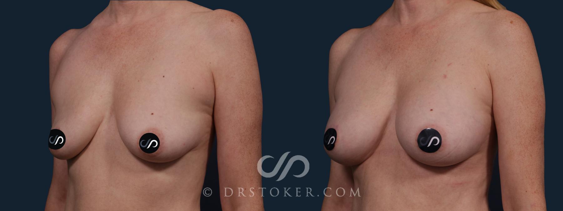 Before & After Breast Augmentation, Rapid Recovery Case 2139 Left Oblique View in Los Angeles, CA