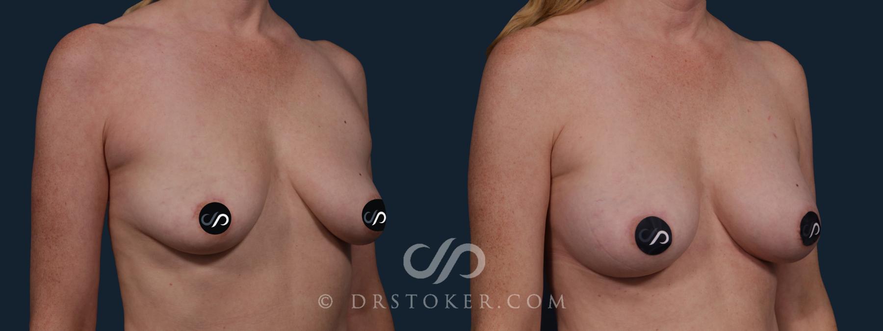 Before & After Breast Augmentation, Rapid Recovery Case 2139 Right Oblique View in Los Angeles, CA