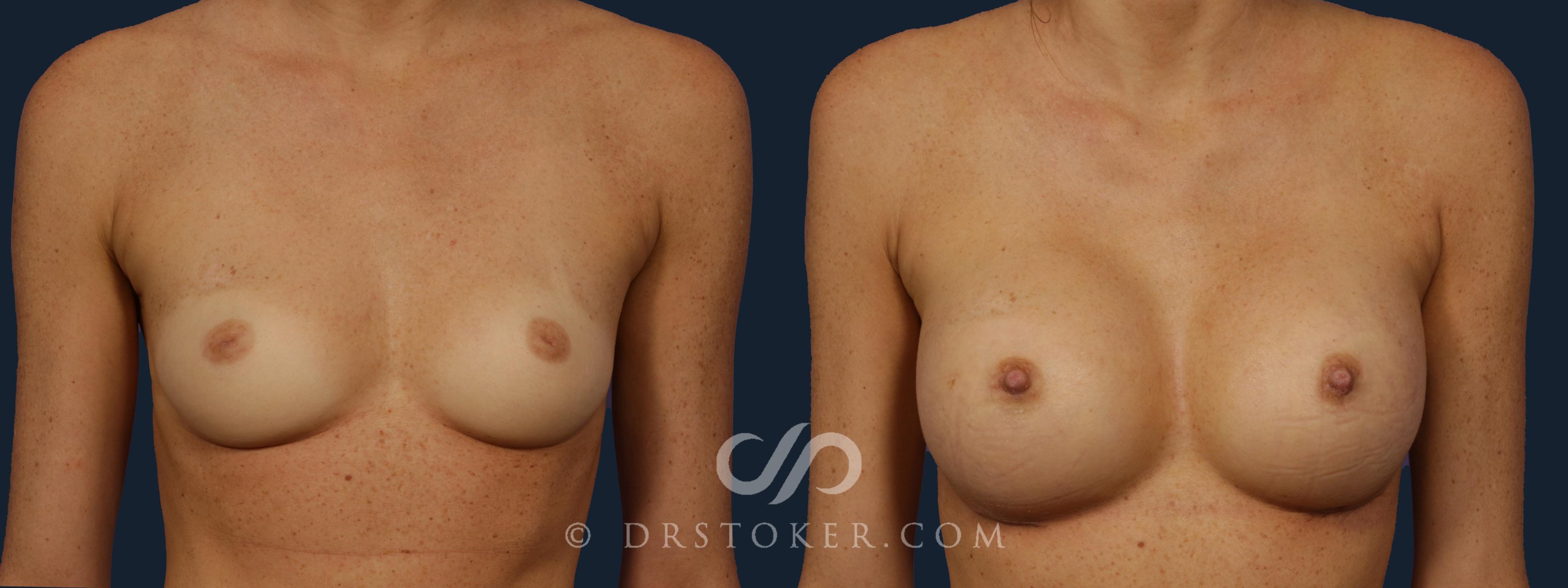 Before & After Nipple - Inversion Correction Case 2149 Front View in Los Angeles, CA