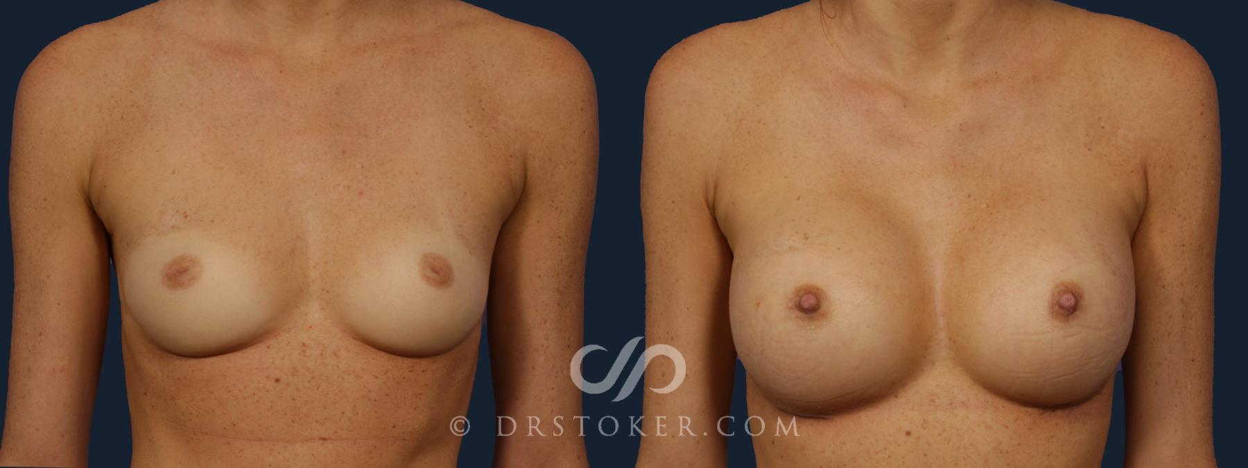 Before & After Nipple - Inversion Correction Case 2149 Front View in Los Angeles, CA