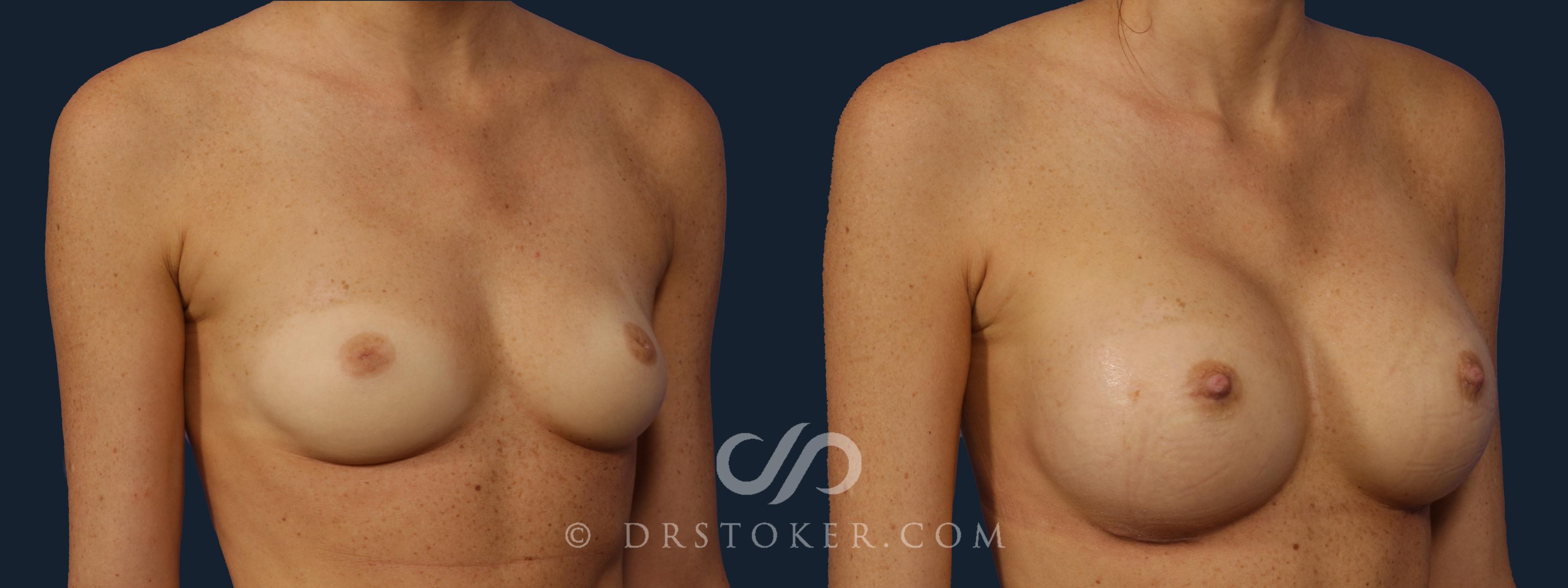 Before & After Breast Augmentation, Rapid Recovery Case 2149 Right Oblique View in Los Angeles, CA