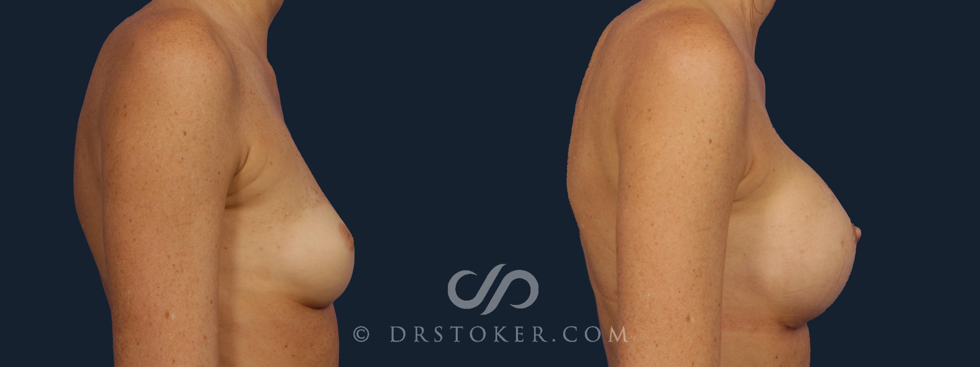 Before & After Breast Augmentation, Rapid Recovery Case 2149 Right Side View in Los Angeles, CA