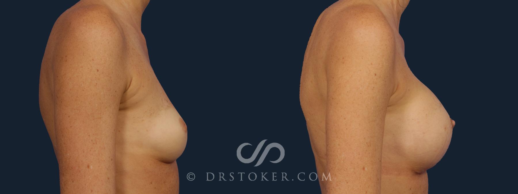 Before & After Nipple - Inversion Correction Case 2149 Right Side View in Los Angeles, CA