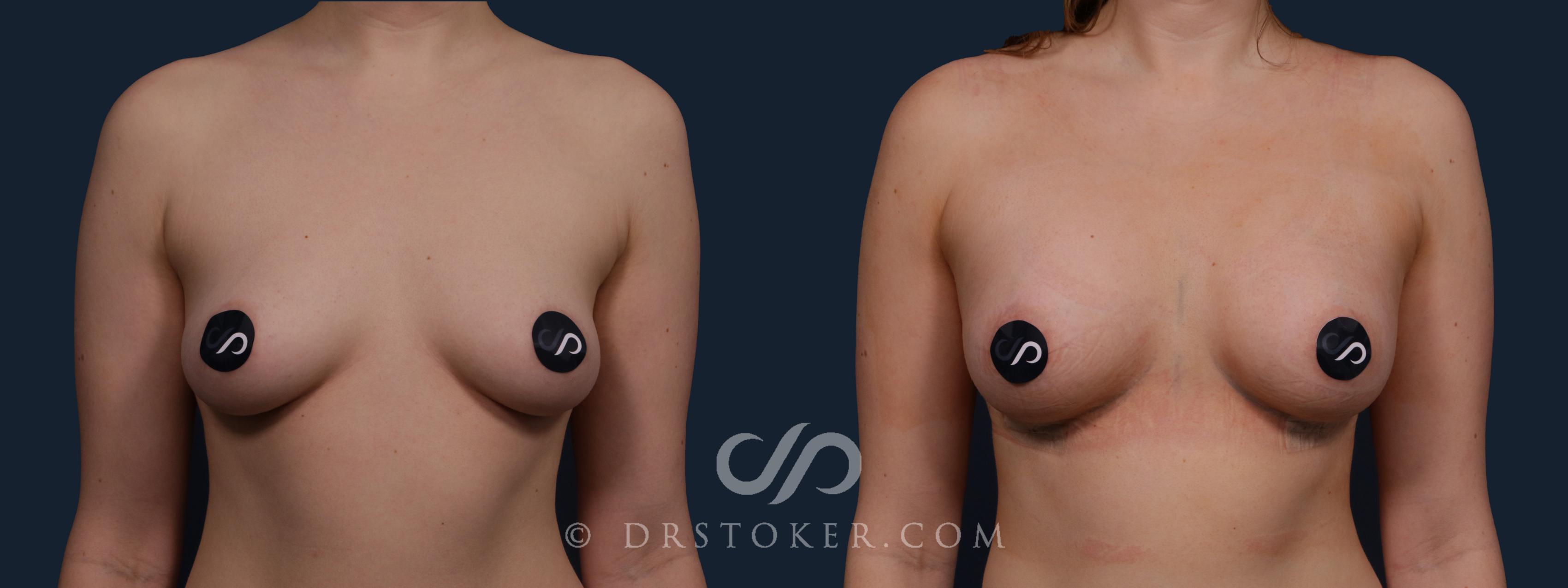 Before & After Breast Augmentation, Rapid Recovery Case 2174 Front View in Los Angeles, CA
