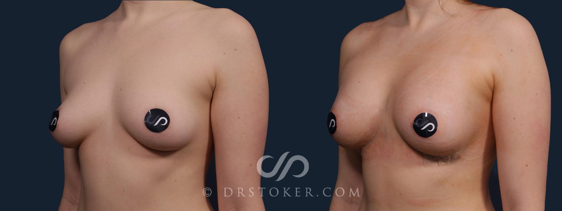 Before & After Breast Augmentation, Rapid Recovery Case 2174 Left Oblique View in Los Angeles, CA