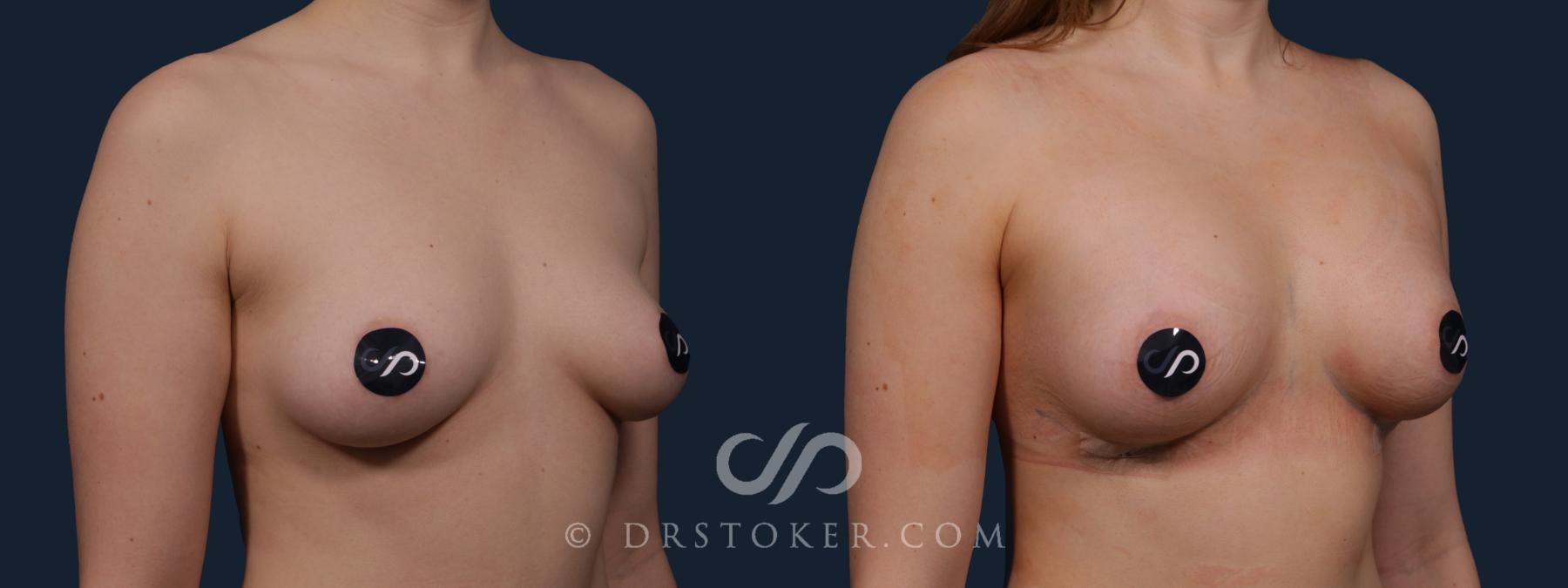 Before & After Breast Augmentation, Rapid Recovery Case 2174 Right Oblique View in Los Angeles, CA