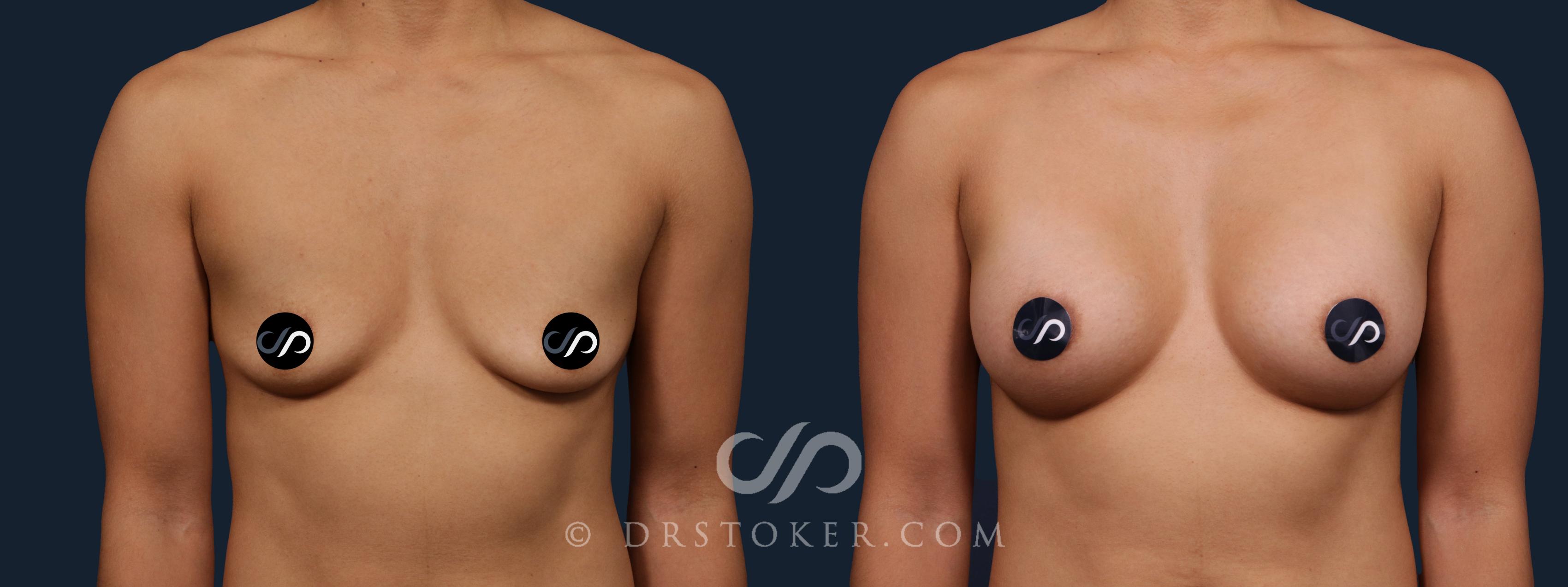 Before & After Breast Augmentation, Rapid Recovery Case 2180 Front View in Los Angeles, CA