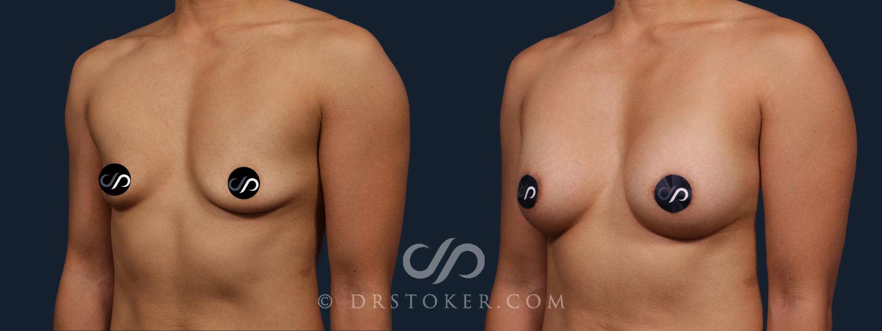 Before & After Breast Augmentation, Rapid Recovery Case 2180 Left Oblique View in Los Angeles, CA