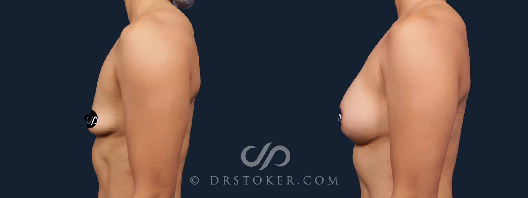 Before & After Breast Augmentation, Rapid Recovery Case 2180 Left Side View in Los Angeles, CA