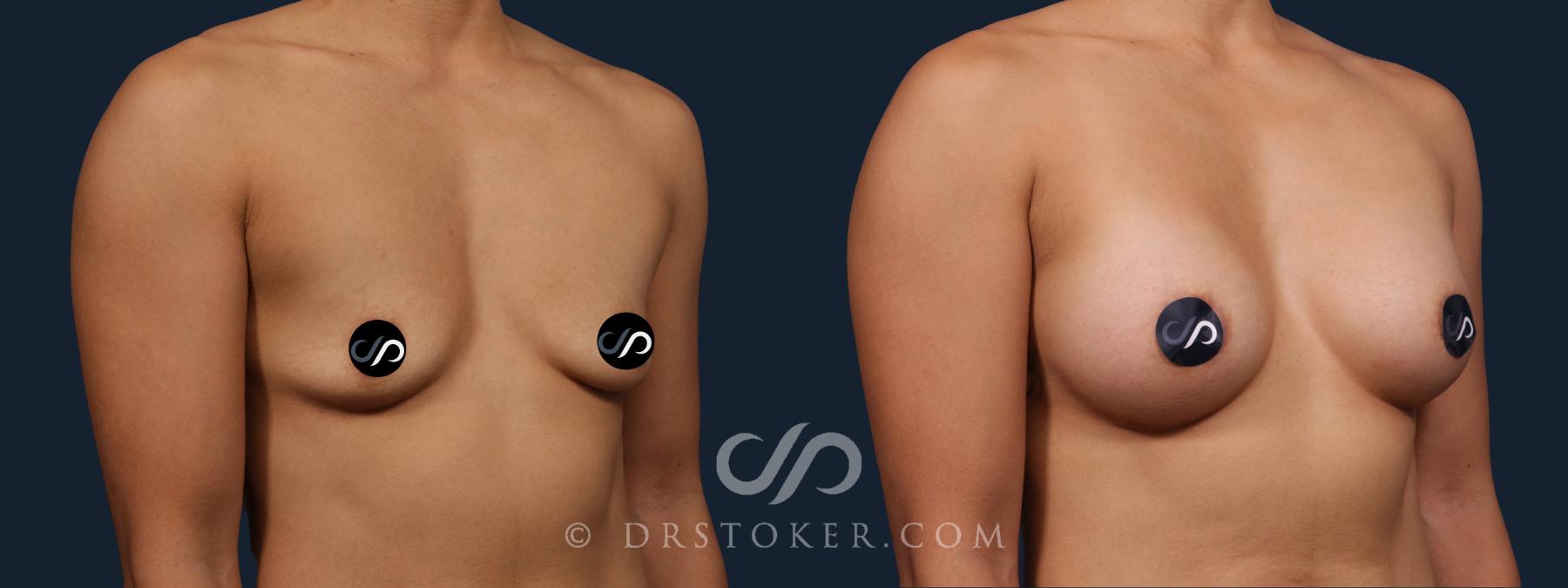 Before & After Breast Augmentation, Rapid Recovery Case 2180 Right Oblique View in Los Angeles, CA