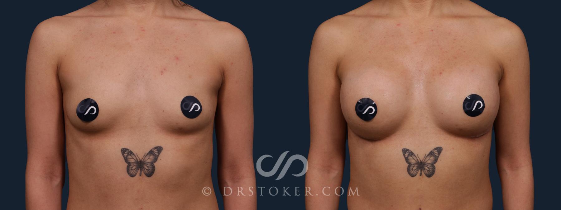 Before & After Breast Augmentation, Rapid Recovery Case 2199 Front View in Los Angeles, CA