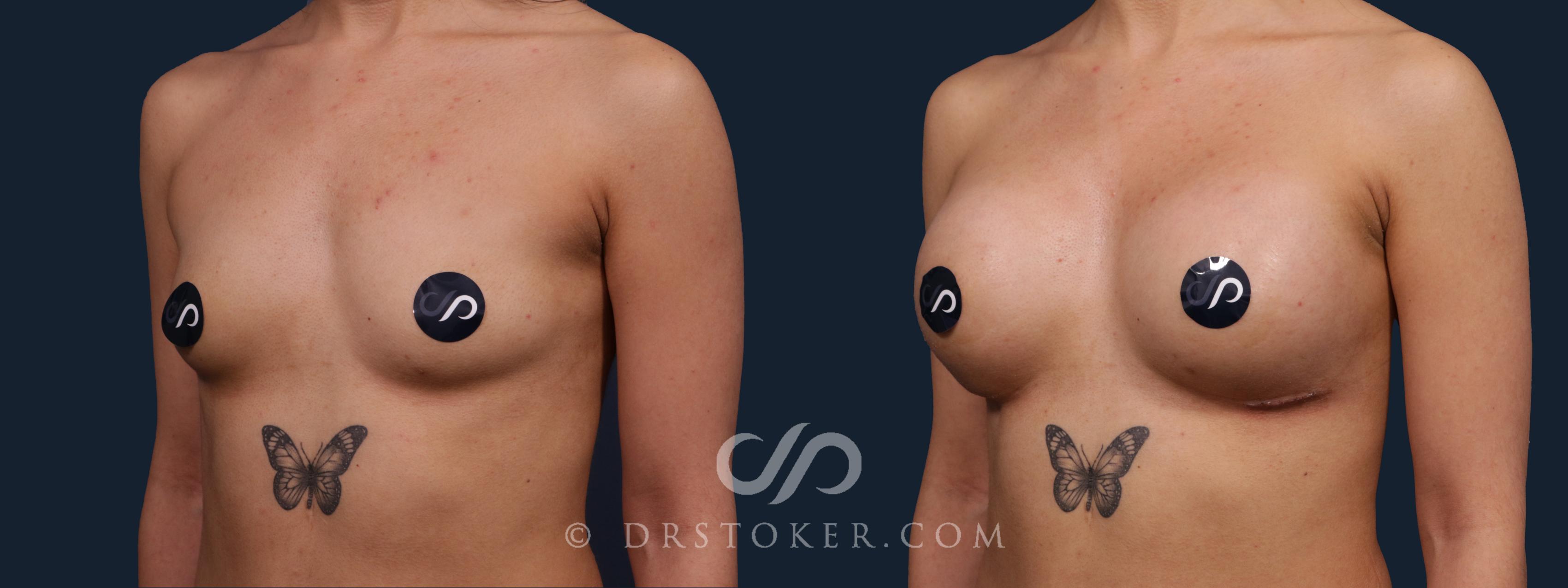 Before & After Breast Augmentation, Rapid Recovery Case 2199 Left Oblique View in Los Angeles, CA