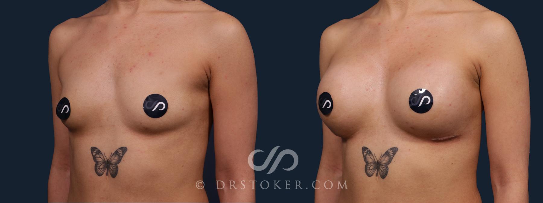Before & After Breast Augmentation, Rapid Recovery Case 2199 Left Oblique View in Los Angeles, CA