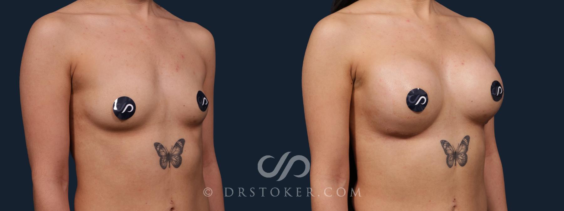 Before & After Breast Augmentation, Rapid Recovery Case 2199 Right Oblique View in Los Angeles, CA