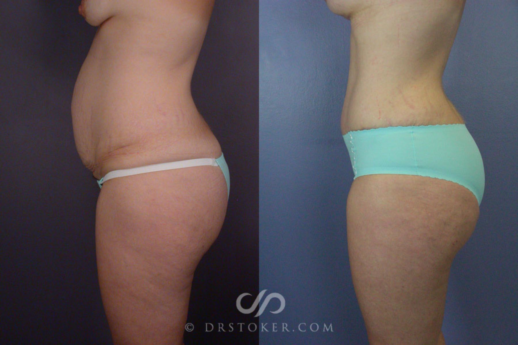 Before & After Tummy Tuck Case 241 View #10 View in Los Angeles, CA