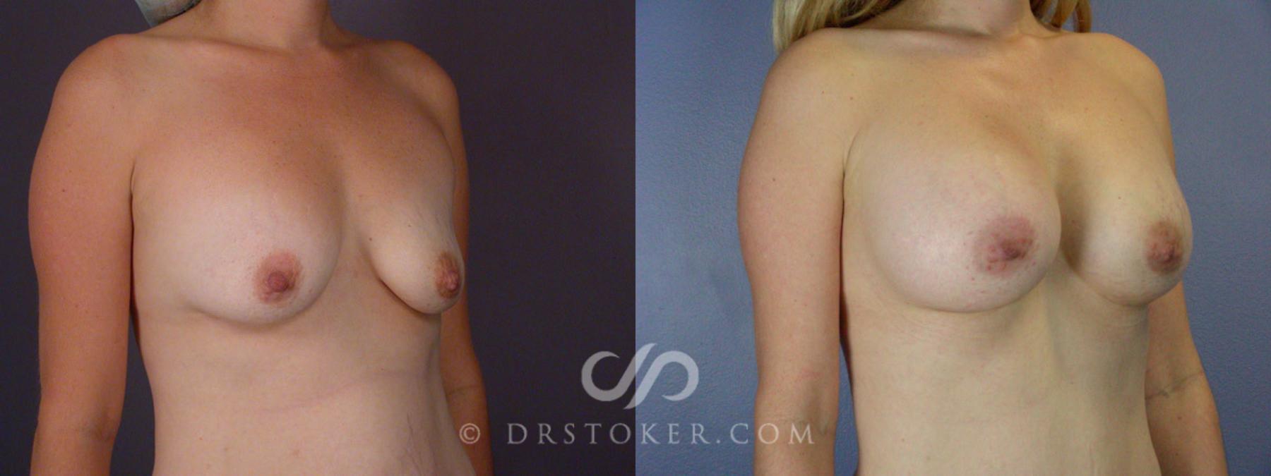Before & After Tummy Tuck Case 241 View #12 View in Los Angeles, CA