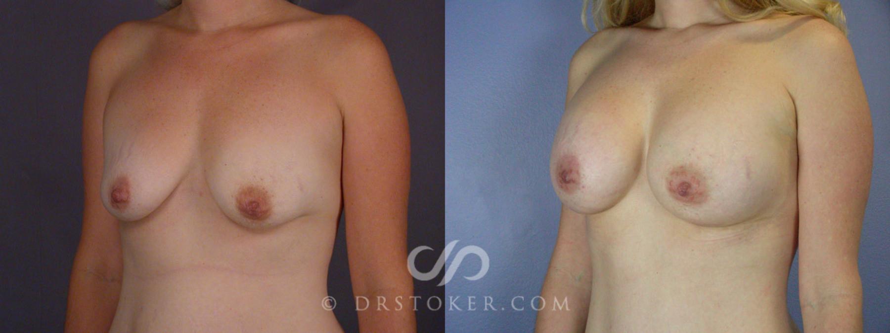 Before & After Breast Augmentation, Rapid Recovery Case 241 View #13 View in Los Angeles, CA