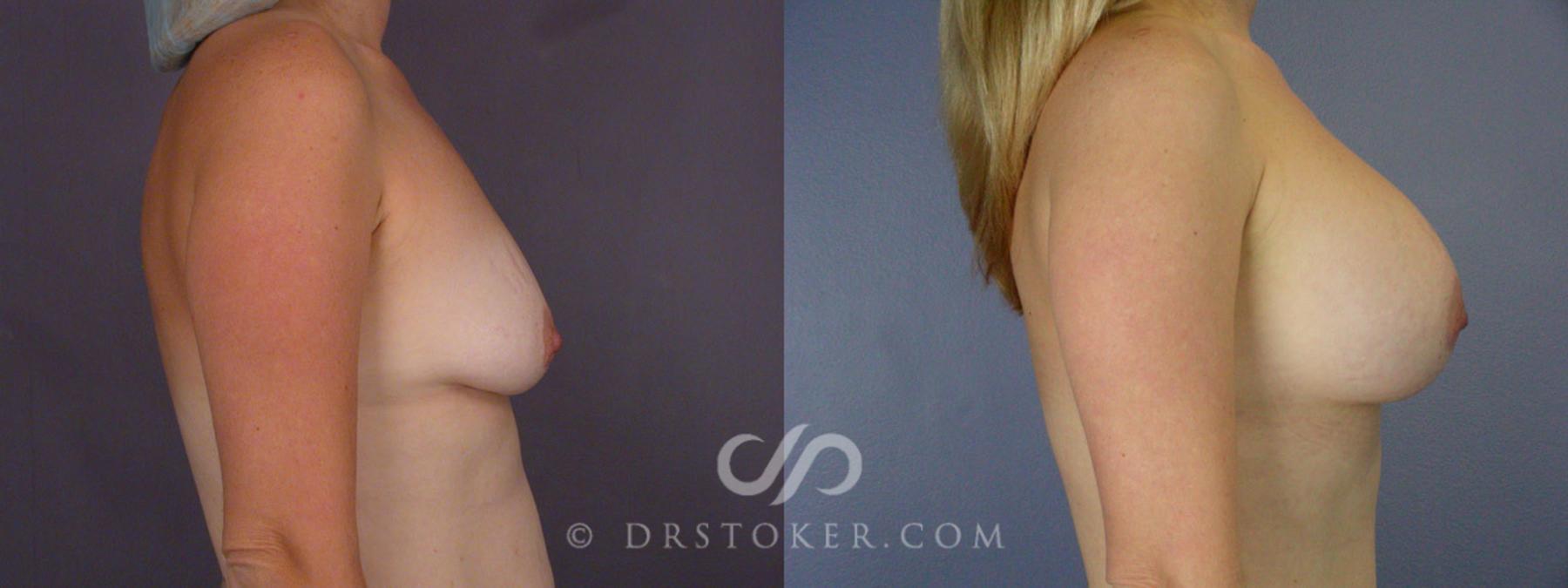 Before & After Breast Augmentation, Rapid Recovery Case 241 View #14 View in Los Angeles, CA