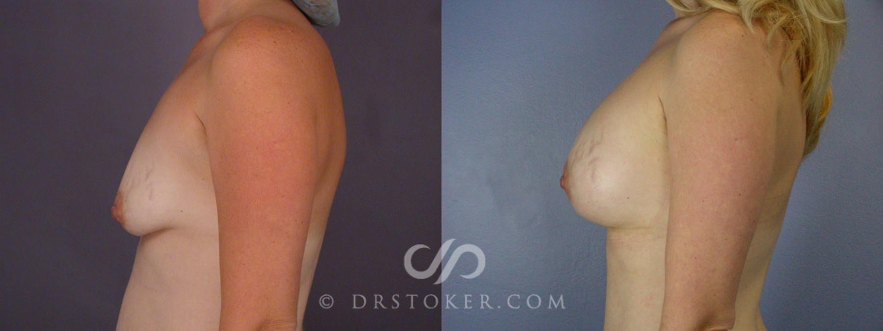 Before & After Tummy Tuck Case 241 View #15 View in Los Angeles, CA