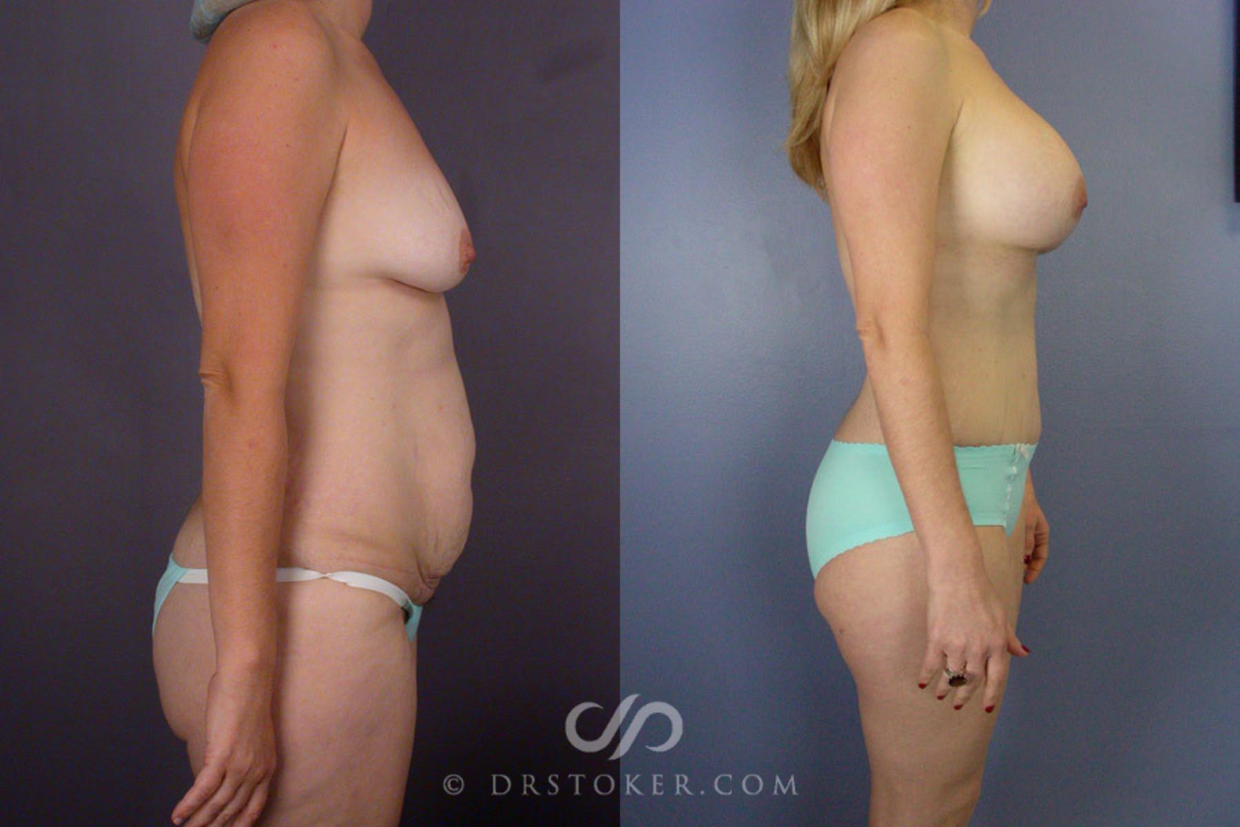 Before & After Tummy Tuck Case 241 View #4 View in Los Angeles, CA