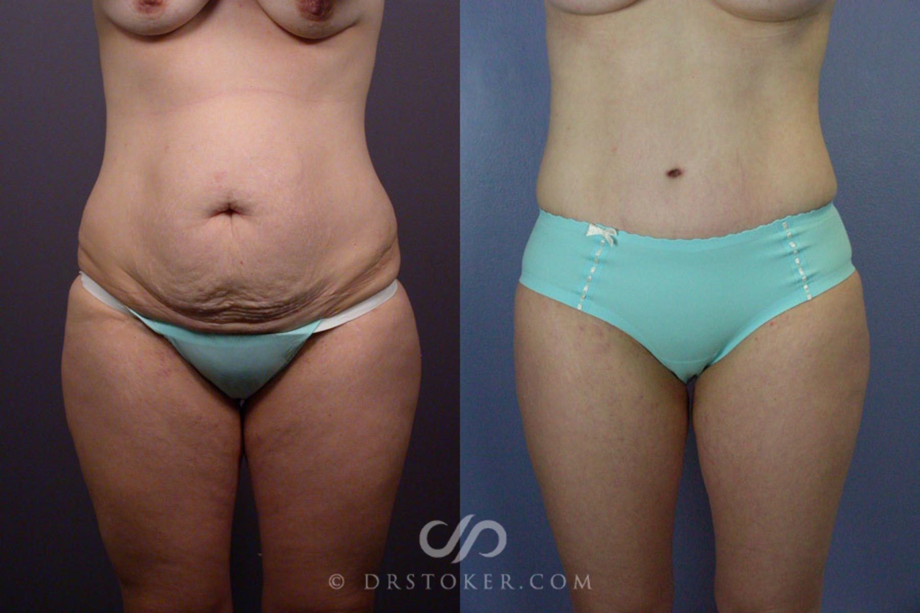 Before & After Tummy Tuck Case 241 View #6 View in Los Angeles, CA