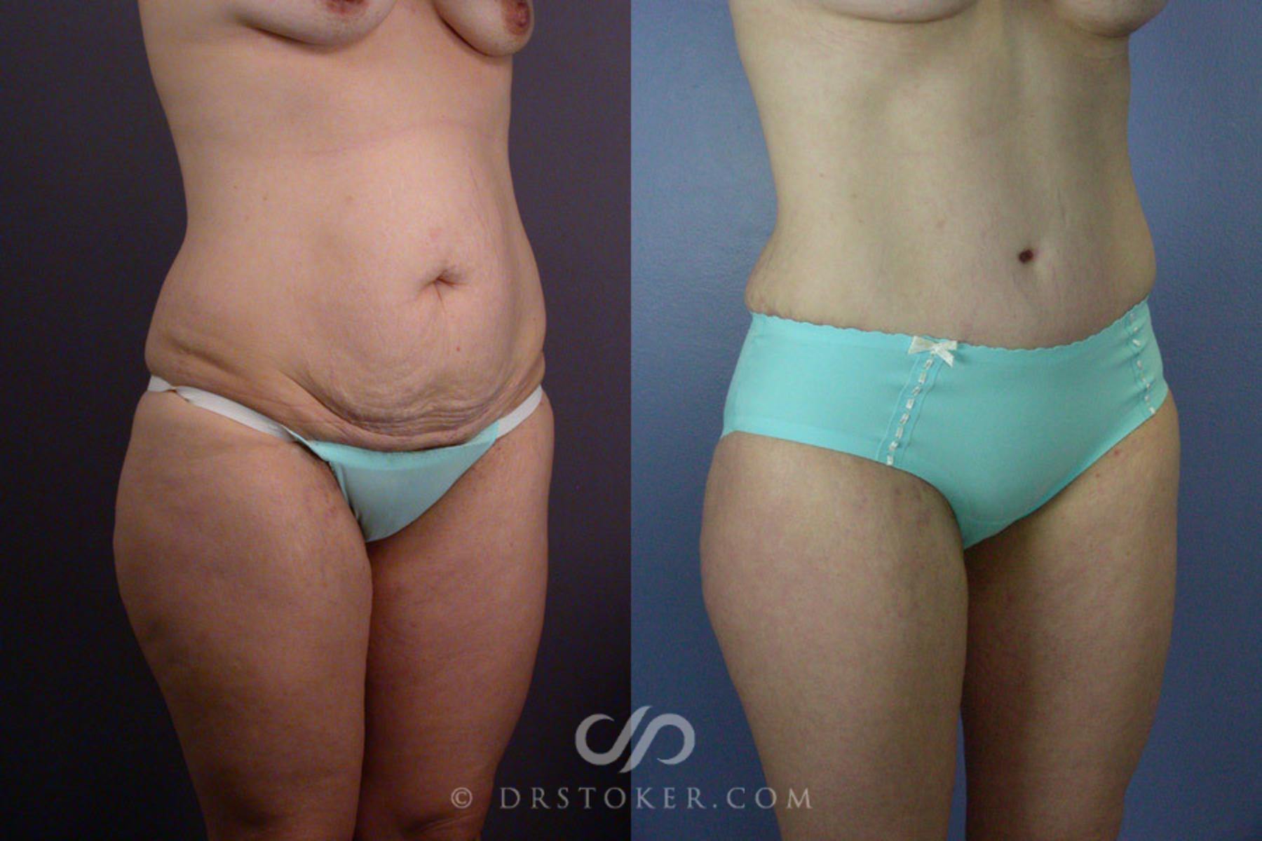 Before & After Tummy Tuck Case 241 View #7 View in Los Angeles, CA