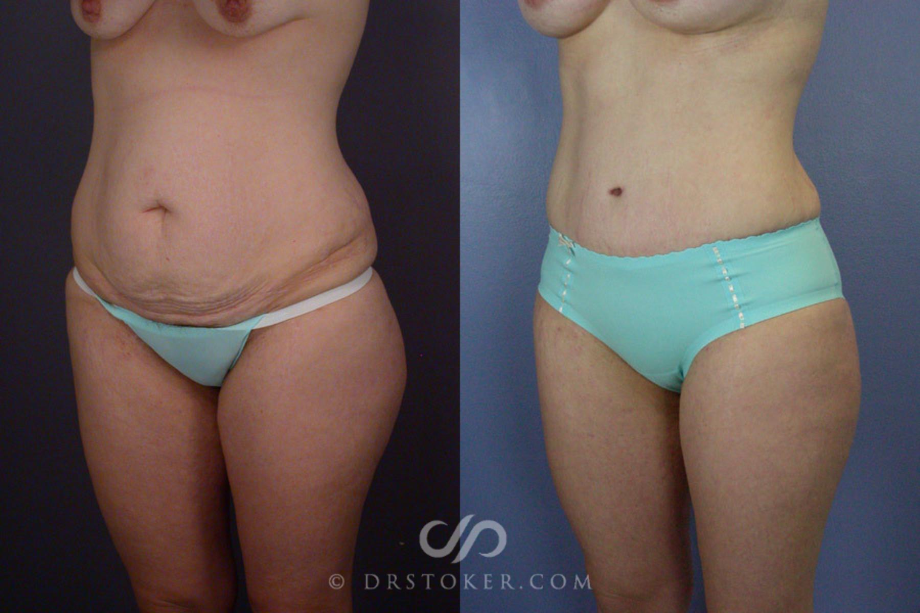 Before & After Tummy Tuck Case 241 View #8 View in Los Angeles, CA