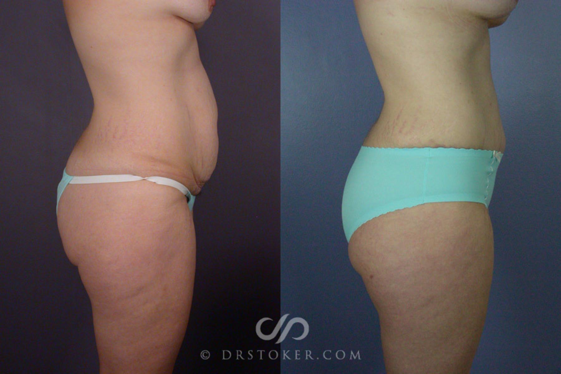 Before & After Tummy Tuck Case 241 View #9 View in Los Angeles, CA