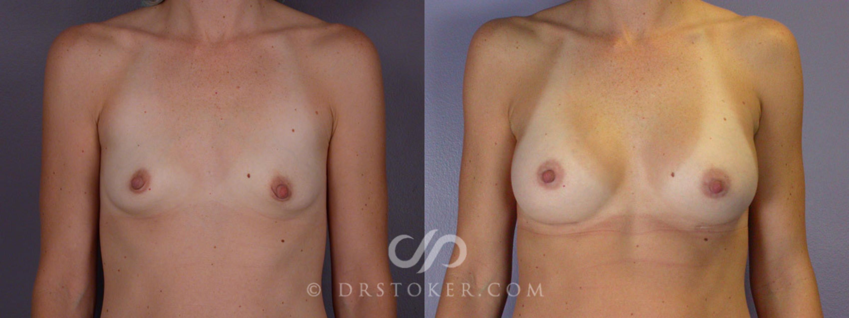 Before & After Breast Augmentation, Rapid Recovery Case 284 View #1 View in Los Angeles, CA