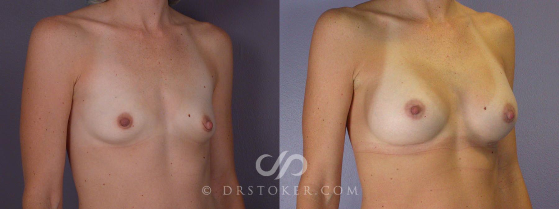 Before & After Breast Augmentation, Rapid Recovery Case 284 View #2 View in Los Angeles, CA