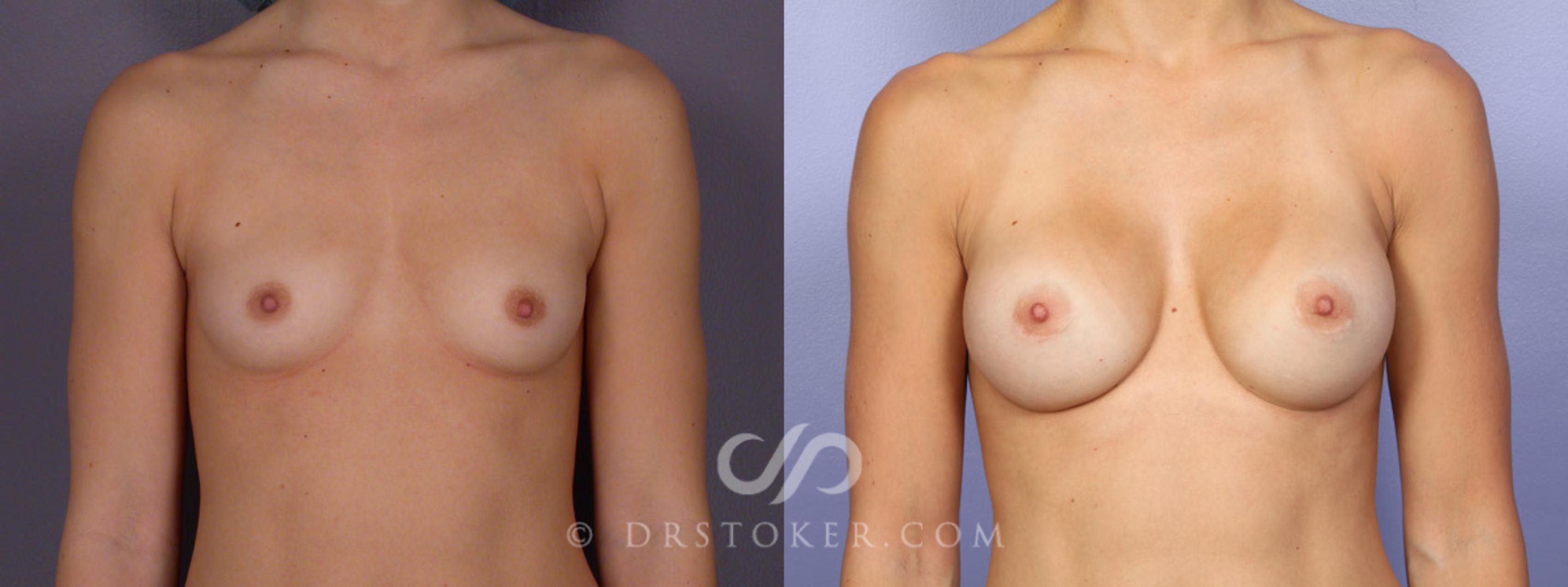 Before & After Breast Augmentation, Rapid Recovery Case 300 View #1 View in Los Angeles, CA