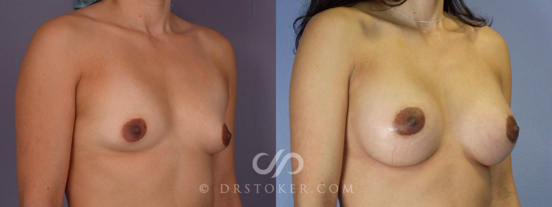 Before & After Breast Augmentation, Rapid Recovery Case 309 View #2 View in Los Angeles, CA