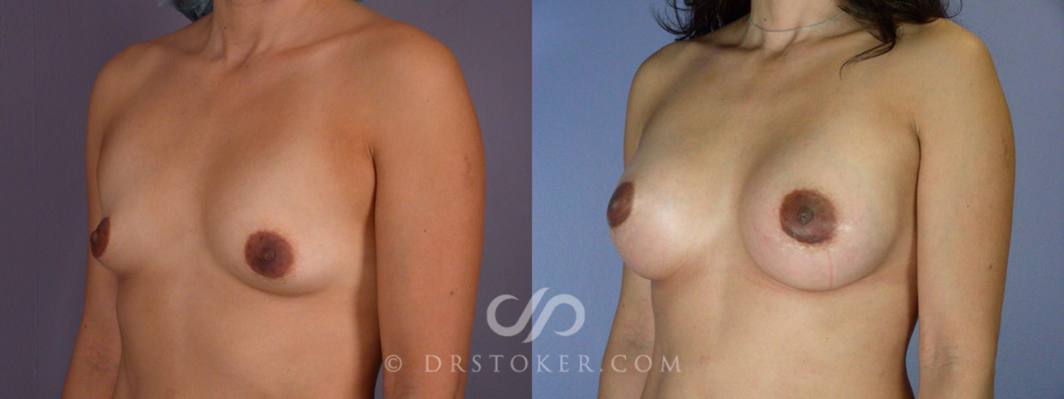 Before & After Breast Augmentation, Rapid Recovery Case 309 View #3 View in Los Angeles, CA