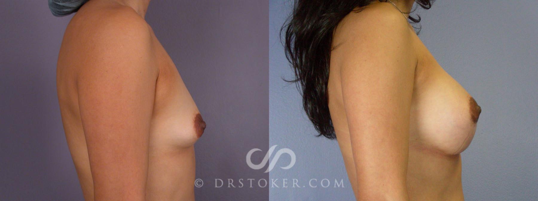 Before & After Breast Augmentation, Rapid Recovery Case 309 View #4 View in Los Angeles, CA