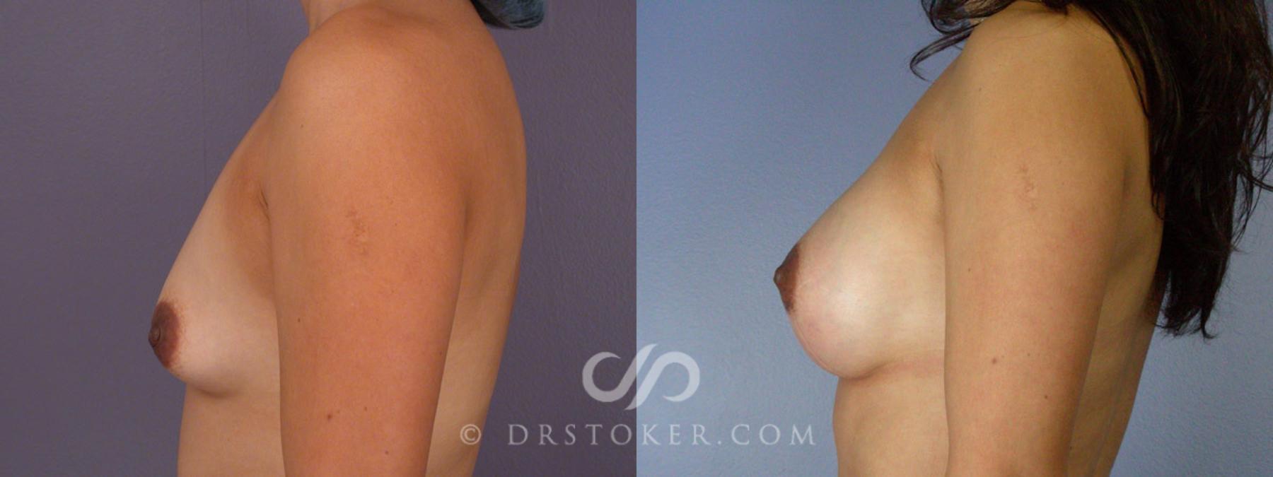 Before & After Breast Augmentation, Rapid Recovery Case 309 View #5 View in Los Angeles, CA