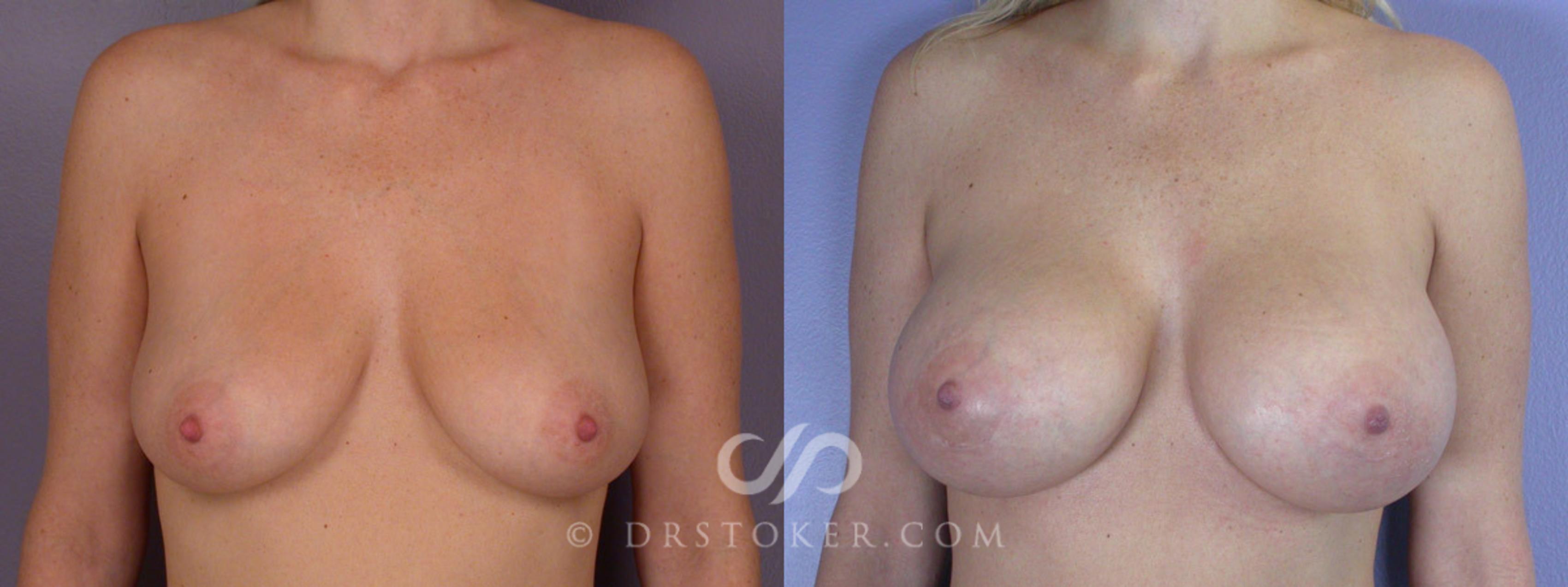 Before & After Breast Augmentation, Rapid Recovery Case 310 View #1 View in Los Angeles, CA