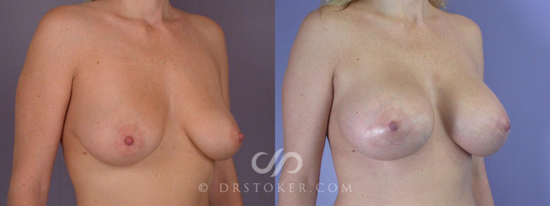 Before & After Breast Augmentation, Rapid Recovery Case 310 View #2 View in Los Angeles, CA
