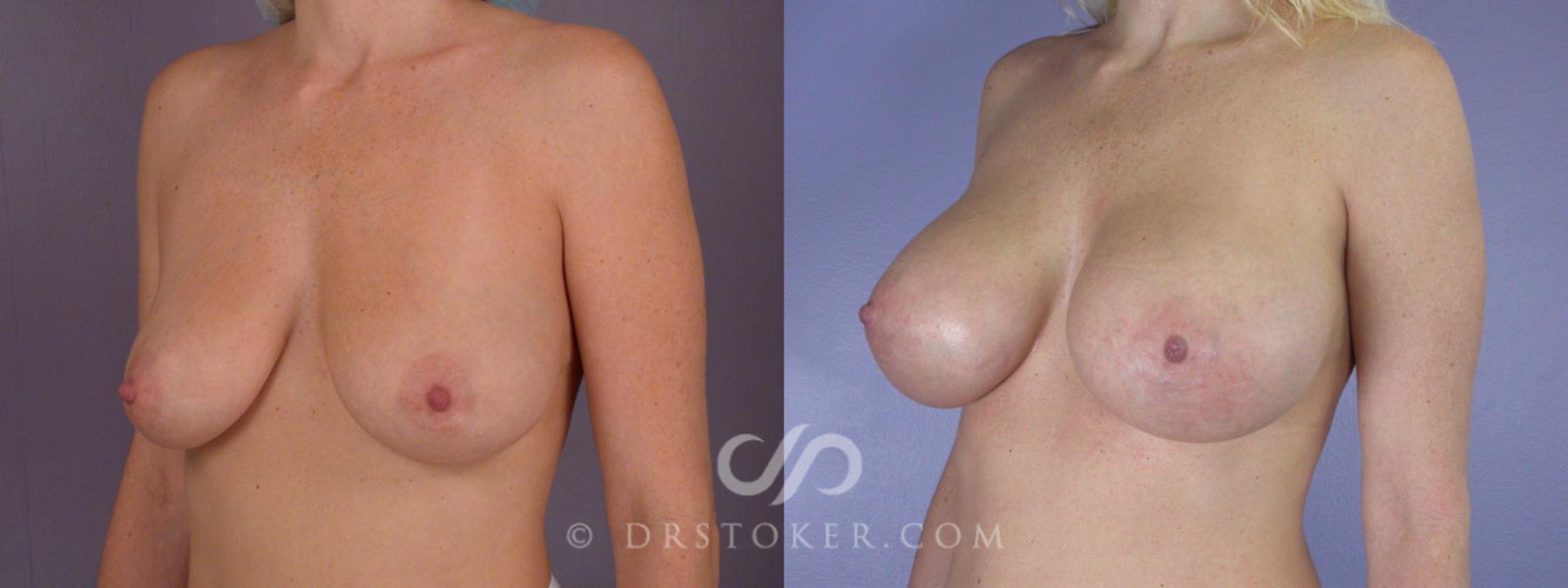 Before & After Breast Augmentation, Rapid Recovery Case 310 View #3 View in Los Angeles, CA